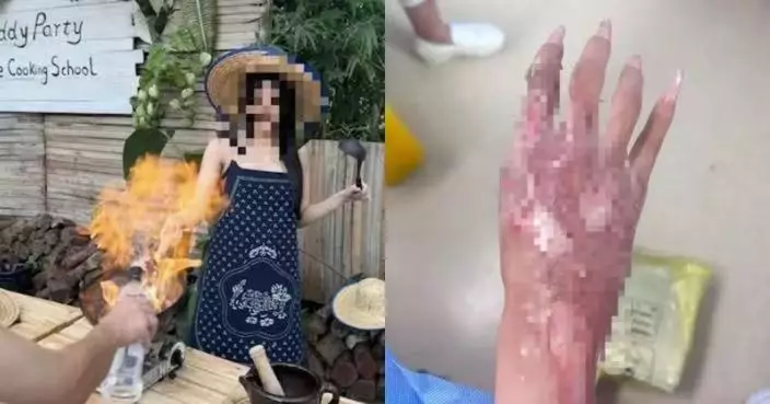 追求拍攝效果釀禍！佛山店員向明火倒烈酒 女客雙手二度燒傷獲賠逾4萬
