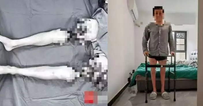 內地男雙側大腿意外遭機器完全截斷 獲醫療團隊施8小時手術接回可借助行器步行