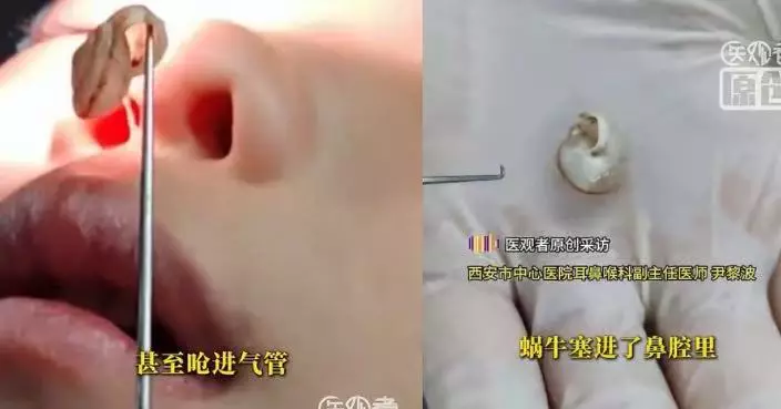 好奇將蝸牛塞入鼻腔 西安3歲女童反覆摳挖推至深處須全身麻醉取出