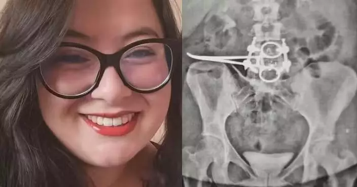 切除子宮後腹痛3個月 巴西女求醫揭腹腔遺留18CM手術鉸剪致小腸壞死