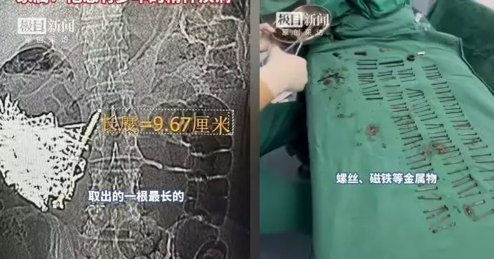 腹痛狂嘔9日 雲南漢求醫揭胃藏180根鐵釘及硬幣磁鐵 醫生施3小時手術取出