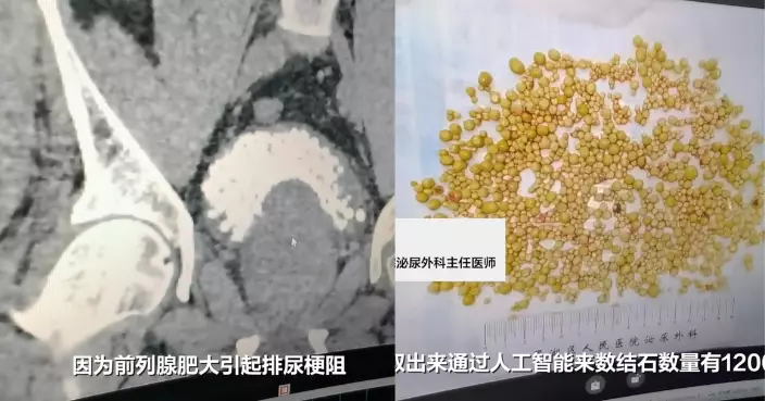 深圳7旬翁膀胱藏巨量結石 逾1200顆需AI點算　醫生：飲水過少