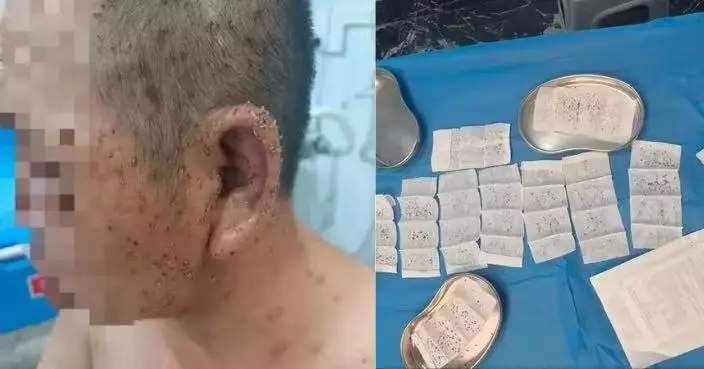 湖北男散步遭群蜂圍攻 身中近千根毒刺多器官受損 醫護搶救48小時救回