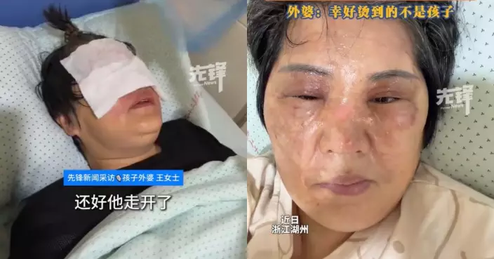 4歲外孫將打火機丟入滾水壺 湖南婦用筷子夾出瞬間爆炸 滾水濺面燙至起泡