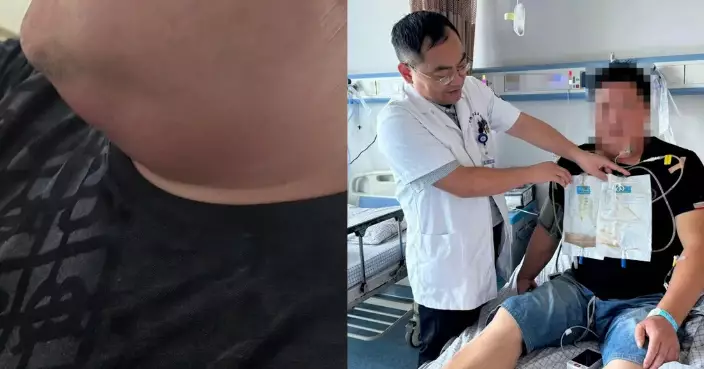 輕微牙痛拖成頸深部感染 內地貨車司機頸內積膿逾800毫升險窒息