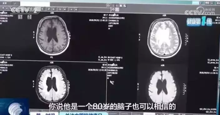長期熬夜玩手機突右手無力 滬49歲男就醫遭揭腦萎縮「堪比80歲長者」