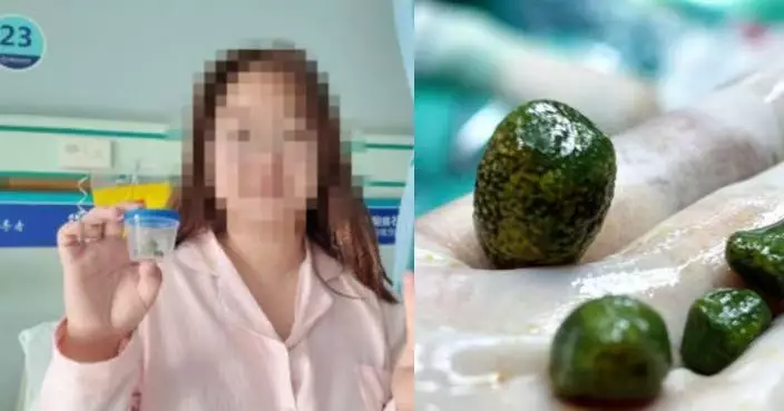 貴陽女膽囊取出4顆翠綠結石似「綠松石」 醫生揭2飲食習慣或增風險