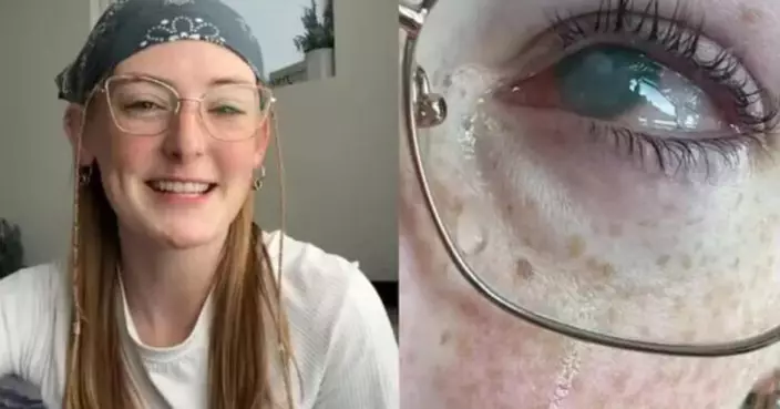 美19歲女戴隱形眼鏡沖涼感染阿米巴變形蟲　右眼幾近全盲