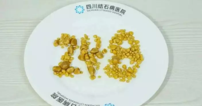 內地26歲男突發劇烈腹痛送醫 手術取出248顆膽結石  血脂超標5倍醫生揭誘因