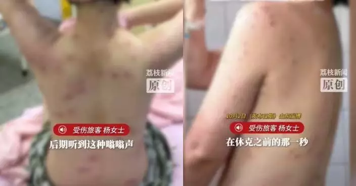 玩高空飛拉達遭黃蜂群圍攻 內地女全身被螫逾180處一度休克
