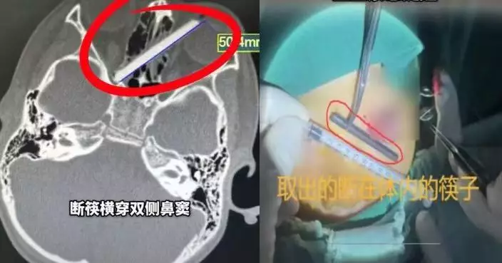 內地男童吃飯跌倒遭5CM斷筷插入眼眶 貫穿鼻竇直逼視神經 醫生施手術取出