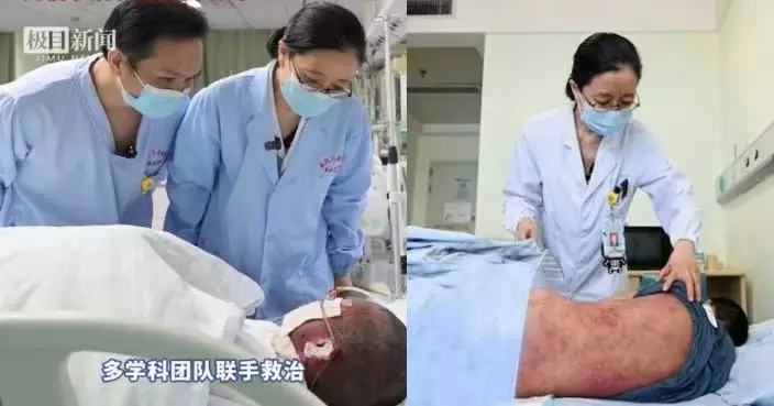 眼痛服藥打針後患罕見重症 武漢10歲男童全身逾8成皮膚剝落如嚴重燒傷