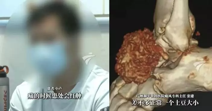14歲已患痛風 廣東男腳生巨型痛風石行路受阻需手術清除