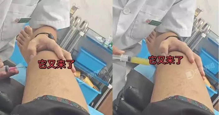 福建男膝蓋腫痛求醫 竟抽出12針筒關節積液 網民：看完膝蓋隱隱作痛