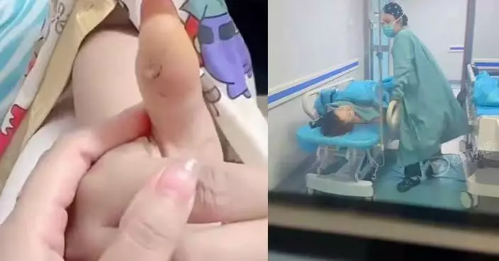 遭螃蟹夾傷僅簡單包紮 河北女傷口嚴重感染險截肢 醫生提醒慎防創傷弧菌