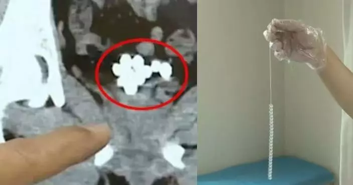 好奇心惹禍！內地男將18CM珠鏈塞入膀胱致交叉打結 醫生警告恐影響性功能
