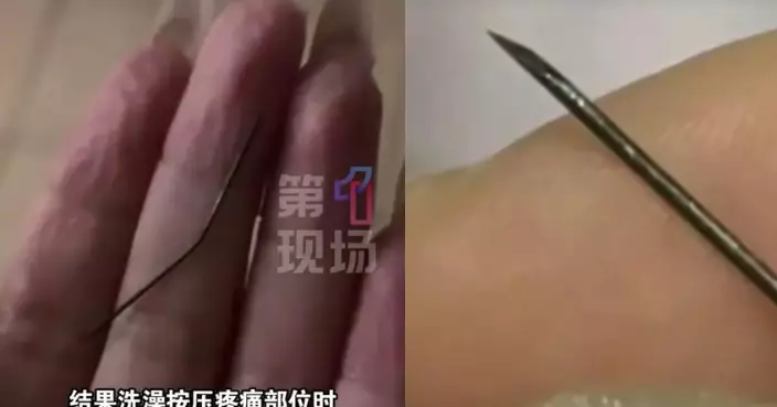 左臀疼痛近1個月以為肌肉拉傷 浙江女沖涼擠出4至5CM發黑針頭 來源成謎