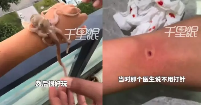 山東女將活八爪魚放手臂拍片 遭緊咬至流血凹陷 醫生：首次接診這類病例