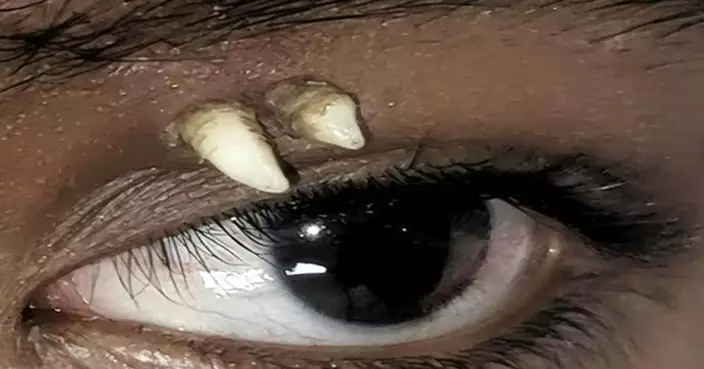 全球首宗！印度少年眼皮無痛腫脹一個月  CT揭完整牙齒藏上眼窩